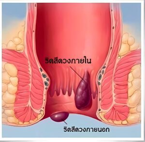 ริดสีดวงทวารภายนอก