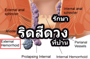 รักษาริดสีดวง ที่บ้าน